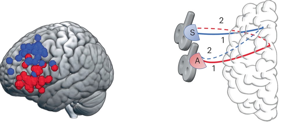 Image 1: Illustration of brain with blue and red circles to indicate functional connectivity peaks to the sgACC and amygdala, respectively, for individual participants. Image 2: Two rTMS coils connected to the front of the brain to indicate where they were applied to target the sgACC and amygdala.